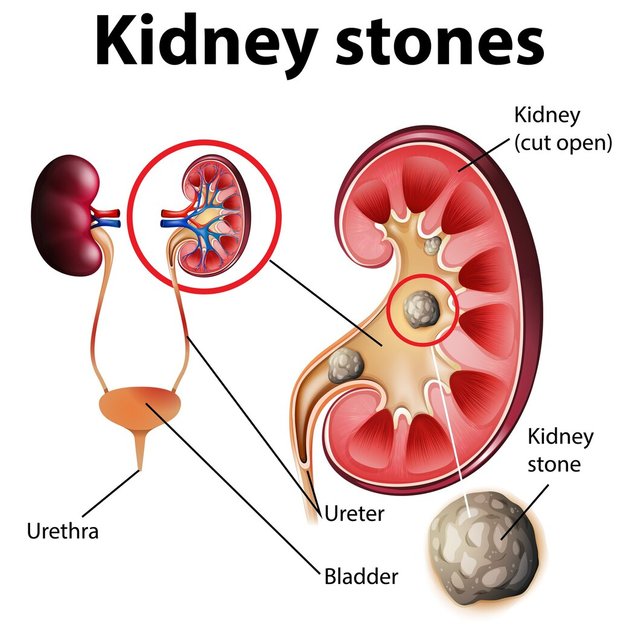 informative-illustration-kidney-stones_1308-51685.jpg