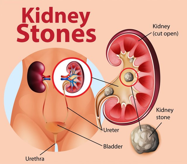 informative-illustration-kidney-stones_1308-47097.jpg