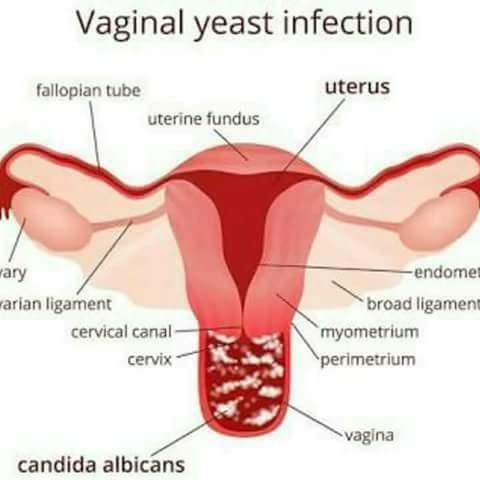 Vaginal Yeast Infection Candidiasis Steemit