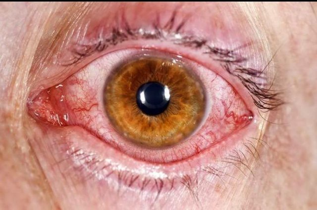 Conjunctivitis :symptoms, causes and remedies — Steemit