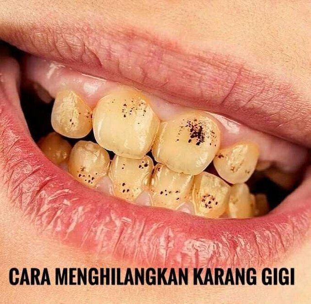 How To Remove The Tooth Reef Cara Menghilangkan Karang Gigi English Indonesia Steemit