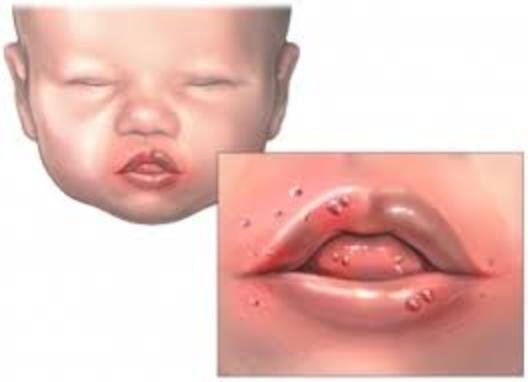 Cold Sores: Why Kissing Babies on the Lips Could Kill Them ...