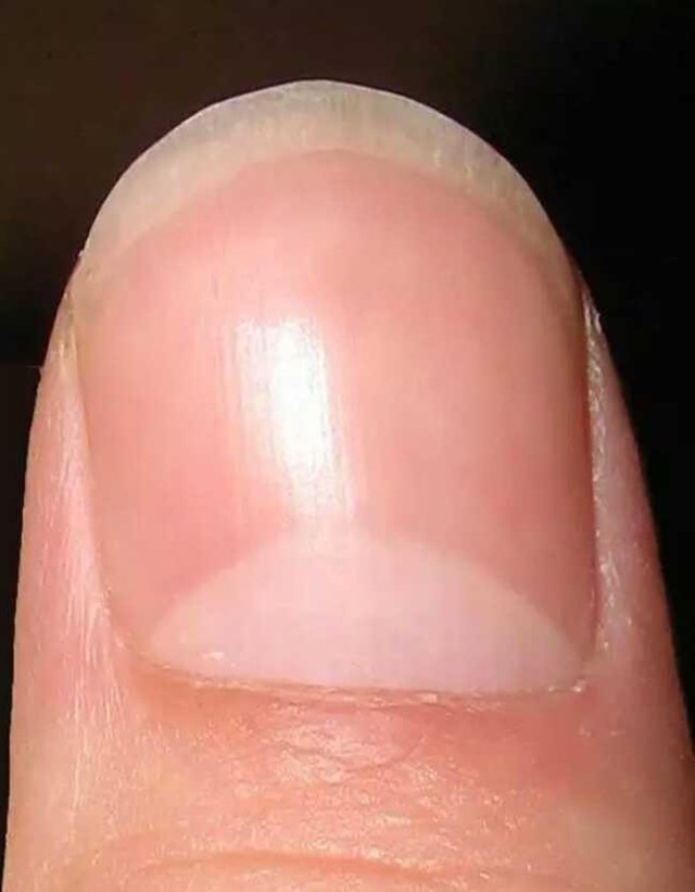 Nail Color Kidney Disease Confession Of Rose