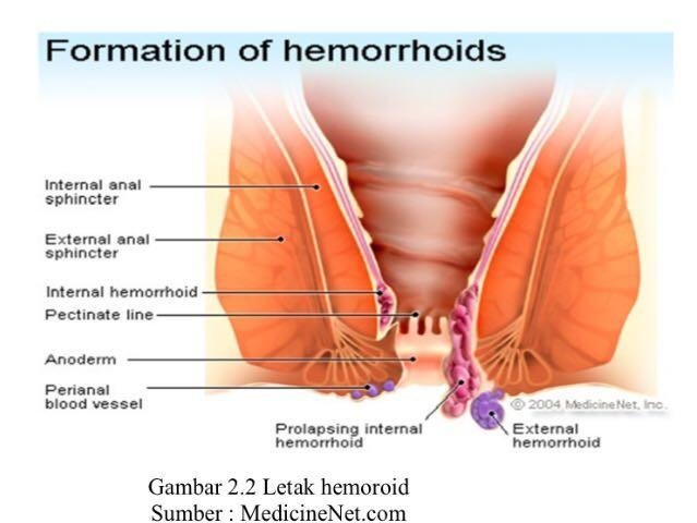 Hemoroid Wasir Berita Biologi