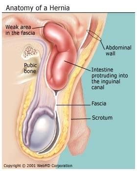 Hernia Treatment, Causes, Inguinal Hernia Repair Surgery, by Alisa  kansakar, All Treatment