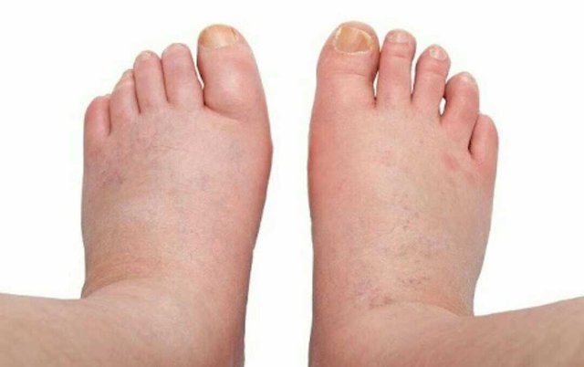 Swollen feet and hands after waking up - Steemit