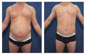 tummy-tuck-male-1-2