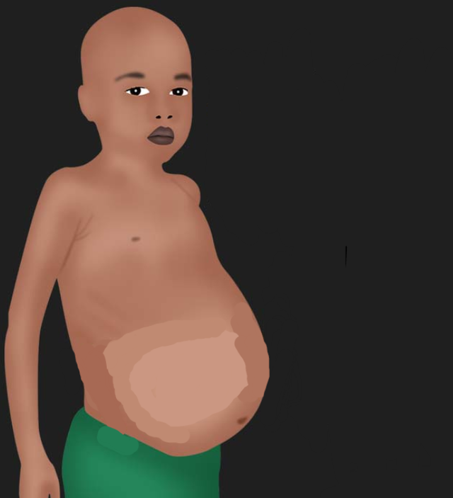 Abdominal swelling in children