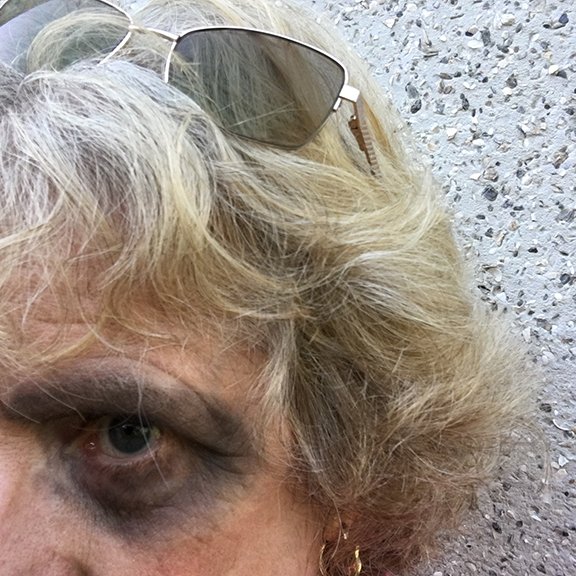 selfie black eye.jpg