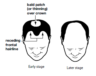 malebaldness.png