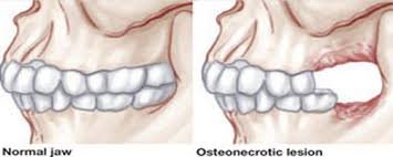 osteonecrosis of jaw.jpg