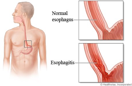 esophagitis.jpg