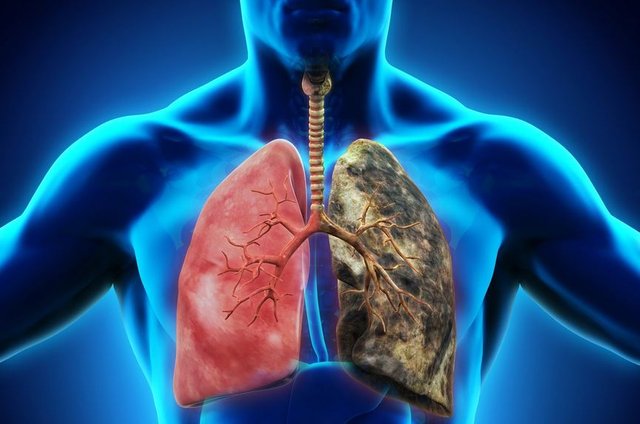 Lung-disease-3-1.jpg