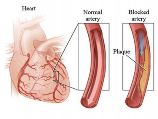 Healthy-clean-arteries.jpg