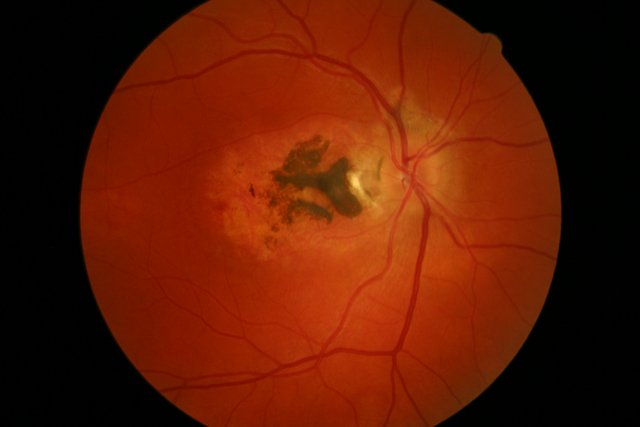 Right_eye_ocular_larva_migrans_granuloma.jpg