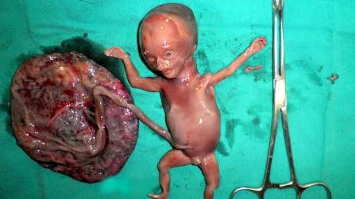 abortion 2.jpg