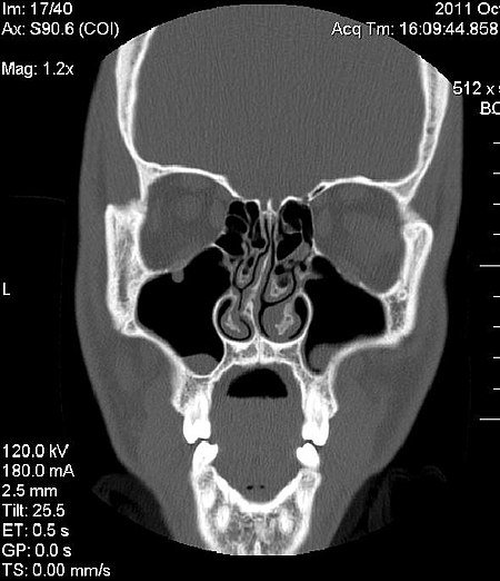 450px-Deviated_Septum_CT_Scan.jpg