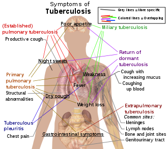 330px-Tuberculosis_symptoms.svg.png