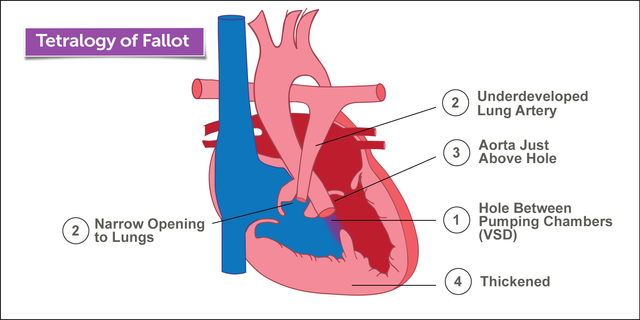 tetrology-of-fallot.png