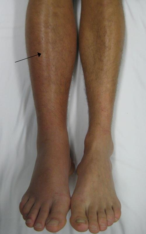 Deep_vein_thrombosis_of_the_right_leg