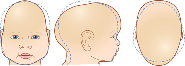 Cranial-Head-Shapes-Sagittal-Synostosis-1030x372.png