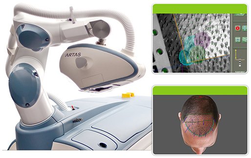ARTAS-Hair-Transplant-robot-.jpg