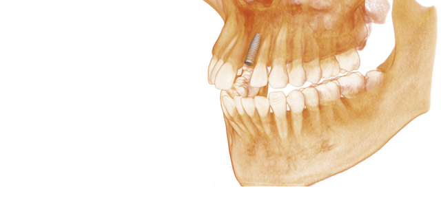 InvivoLight-volume-render-implant-anatomage.png