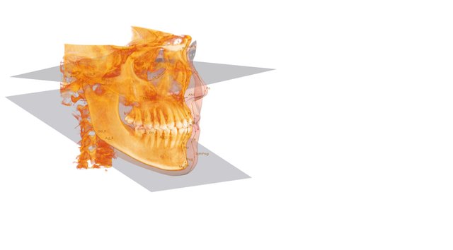 3D-Analysis-Invivo-Anatomage-long-jpg.jpg