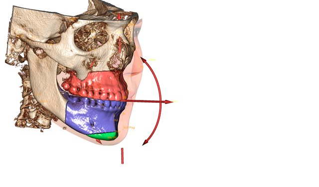 3da-surgery-face-wrap-1-Anatomage-3D-Analysis-LONG-jpg.jpg