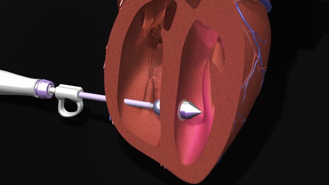 Balloon-Catheter-Featured-Image.jpg