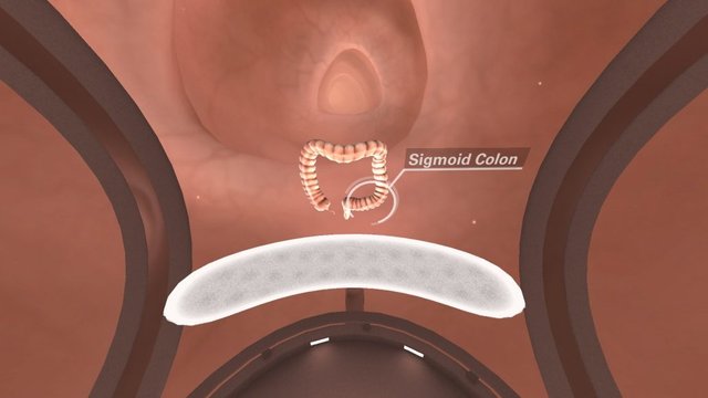 Parallax_ColonCrossing_SigmoidColon-1030x579.jpeg