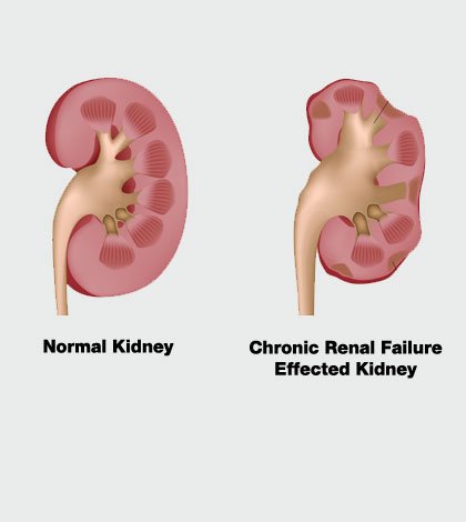 failure renal chronic signs symptoms source