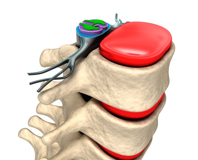 Sciatica MRI