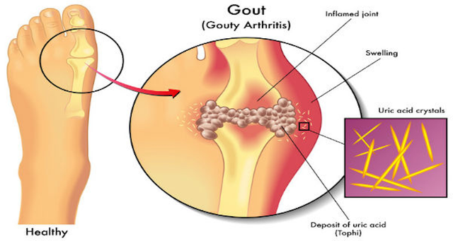 How-To-Remove-Uric-Acid-Crystallization-In-Joints.png