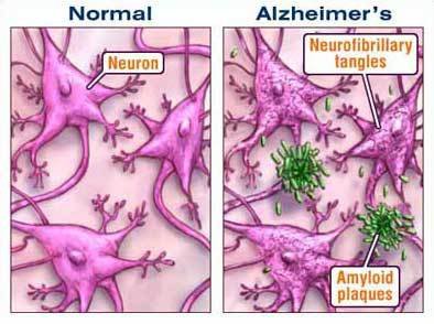 alzheimers-brain1.jpg