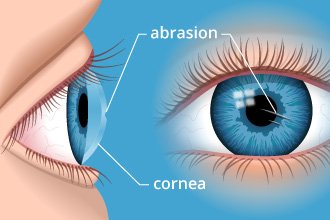 corneal-abrasion-330x220.jpg