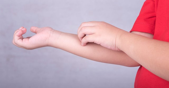 eczema-in-infants-and-children.jpg