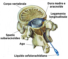 551px-Anestesia_spinale.png