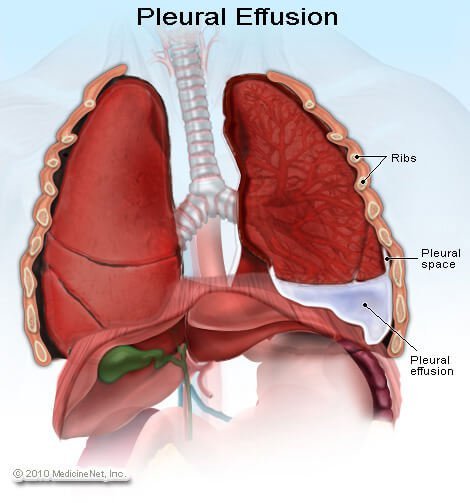 pleural-effusion.jpg