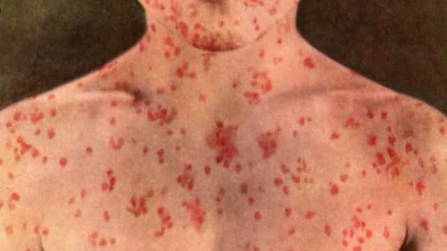 measles-696x392.jpg