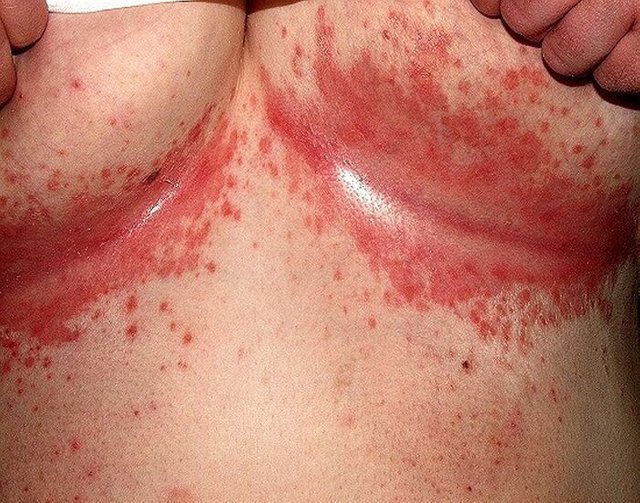 Breast Rash: “Warning” GRAPHIC IMAGES!!! Reality Check For Both