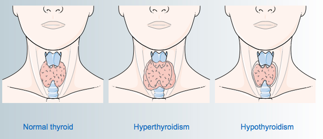 servier_thyroid-diseases1.png