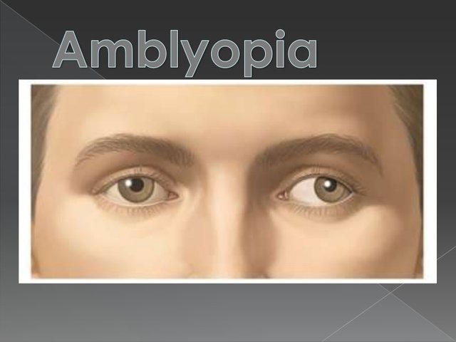 amblyopia-120207190855-phpapp02-thumbnail-4.jpg