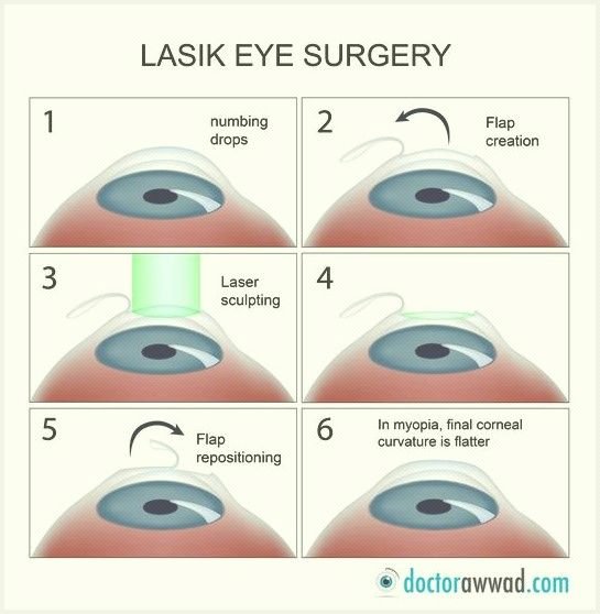 what-can-lasik-correct-can-lasik-2_1.jpg