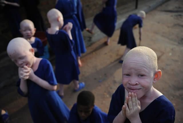 albinos-tanzania-11-1.jpg