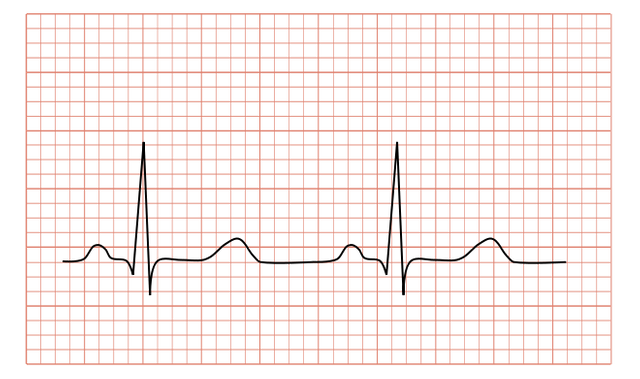 660px-Normal_ECG_2.svg.png