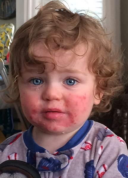 14_month_old_with_Fifth_Disease.jpg
