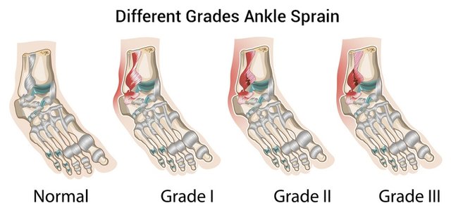 Graded-ankle-sprain.jpg