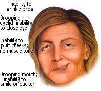 Parálisis Facial 2.JPG