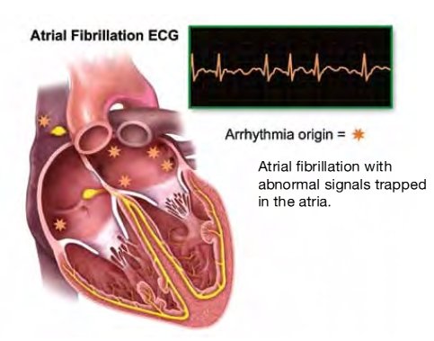 Afib%20EKG.jpg